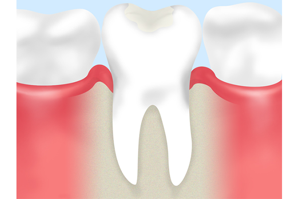 乳歯の初期虫歯は白くなります